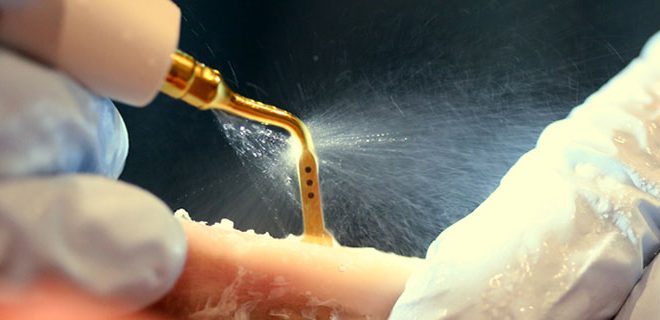 Видалення зубів мудрості ультразвуком